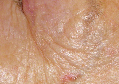 weißer Hautkrebs im Bereich der Krähenfüsse