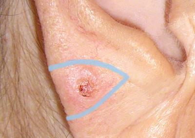 Basaliom am Ohrläppchen