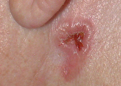 Basaliom hinter dem Ohr